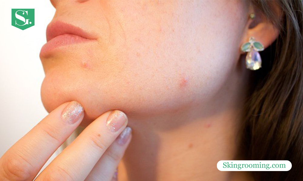 what-causes-acne-around-the-mouth