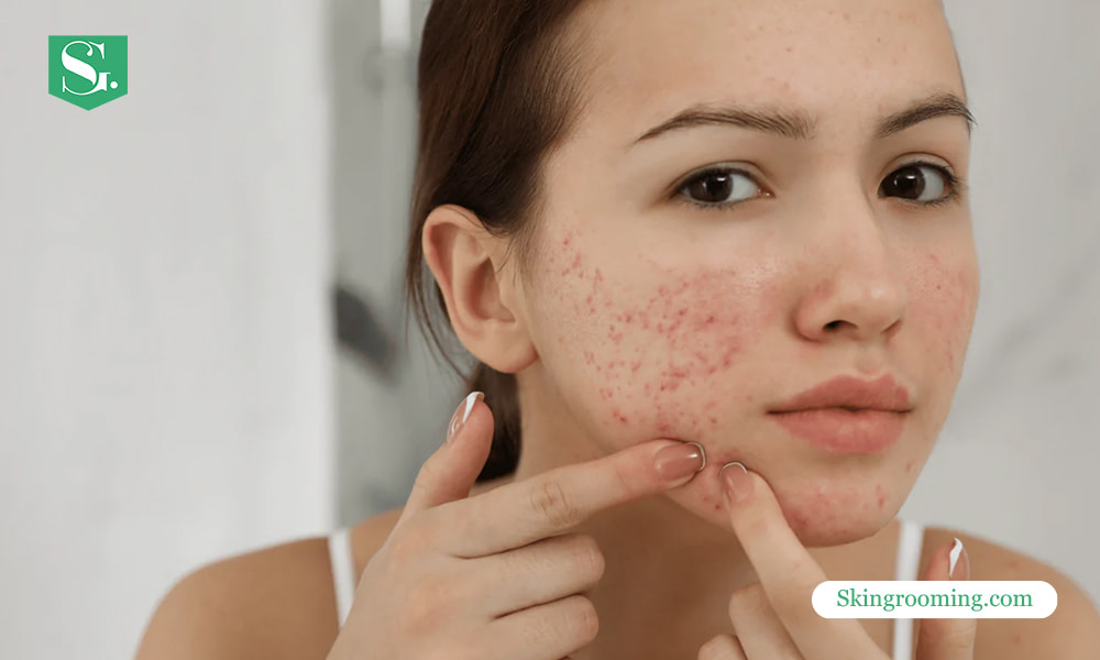 at-what-age-is-acne-the-worst