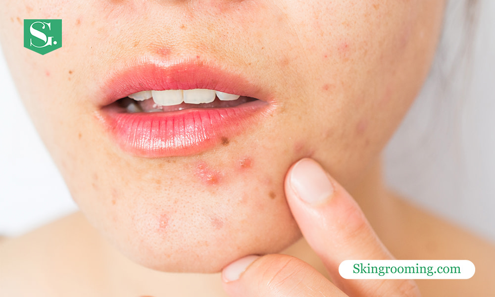 does-collagen-help-with-acne