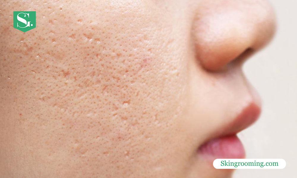 acne-marks-vs-acne-scars