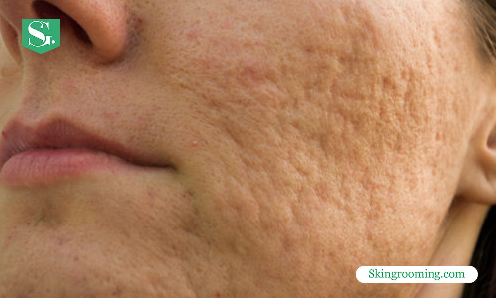 acne-marks-vs-scars