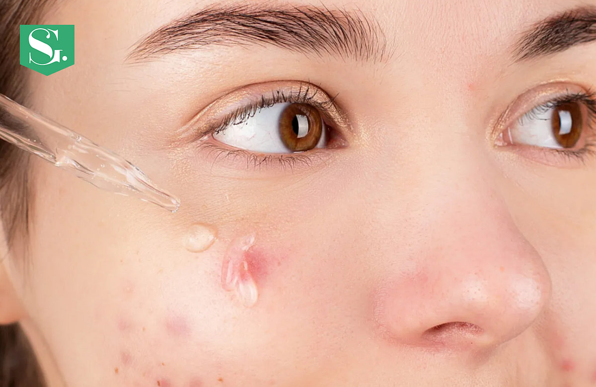 Does Collagen Help with Acne: The Truth Unveiled