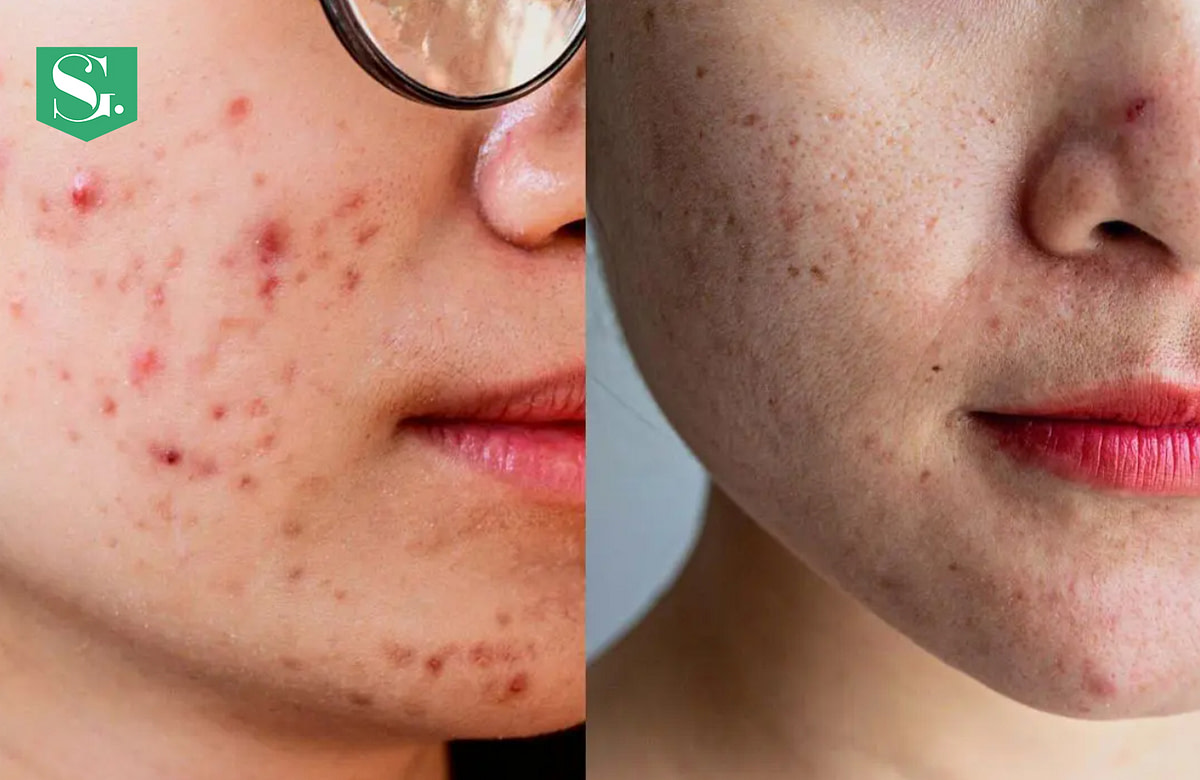 Acne Marks vs Acne Scars: Understanding the Difference