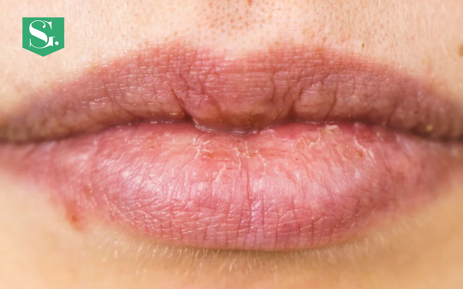 how-to-get-rid-of-scars-on-lips