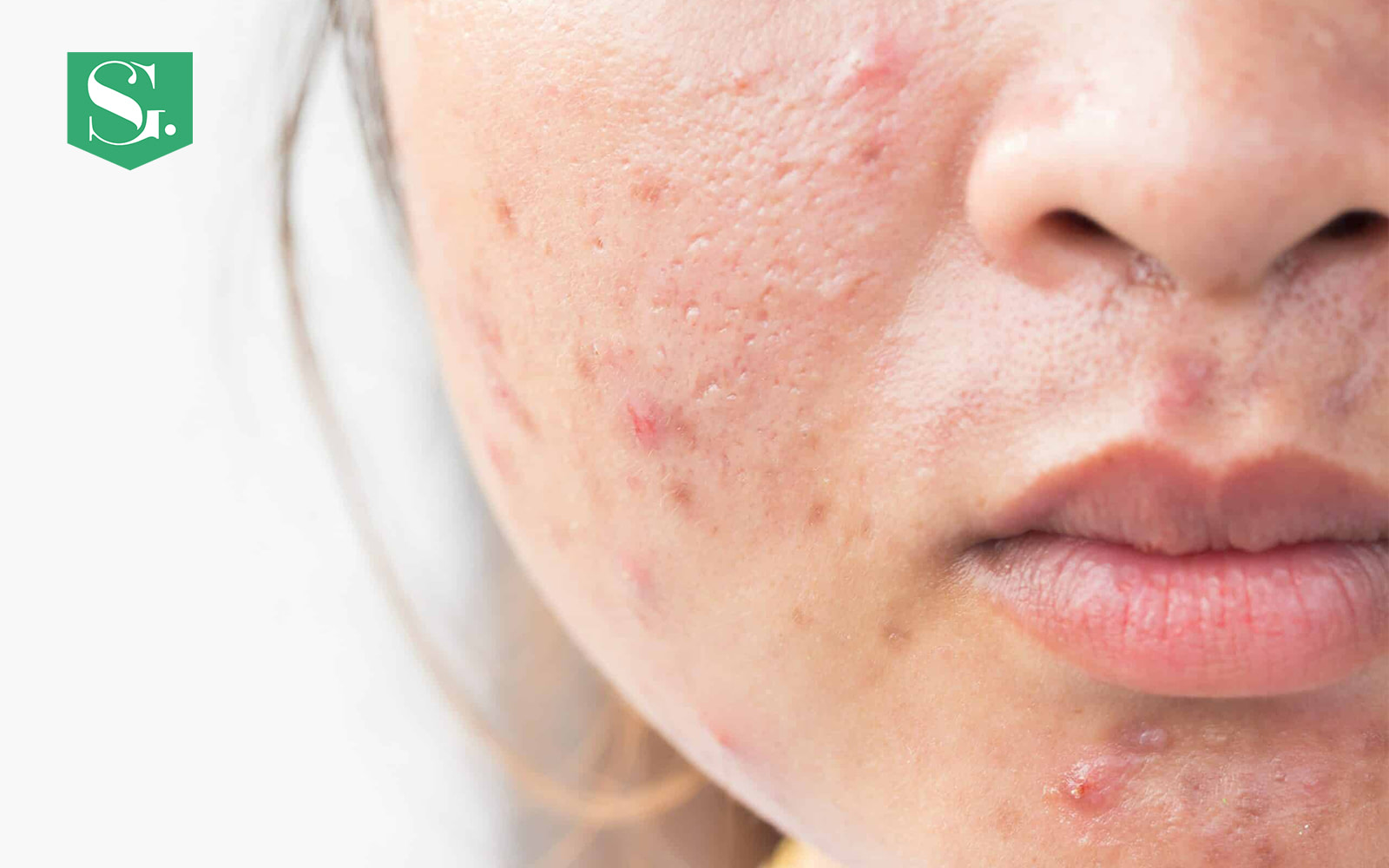 How-to-remove-acne-scars-naturally-in-a-week