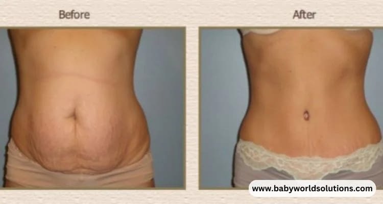 saggy-belly-after-c-section